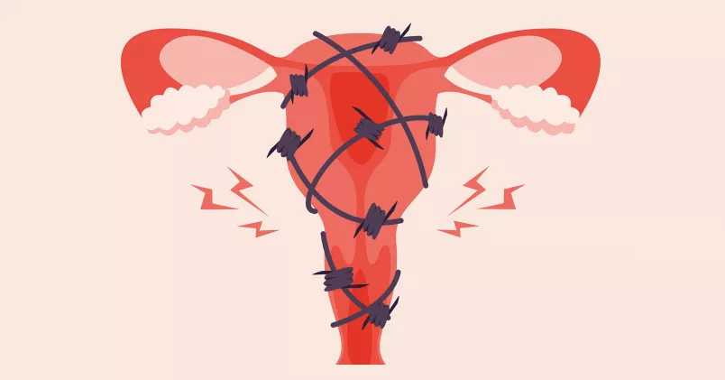 En livmoder med taggtråd runt.