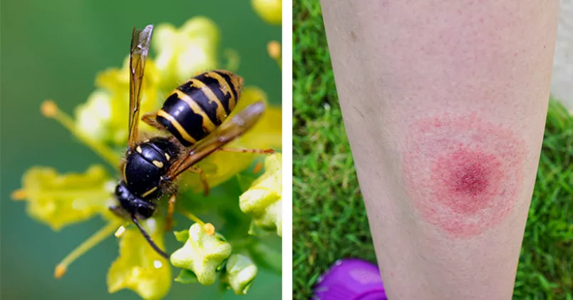 Bi på blommor och ben med fästingbett