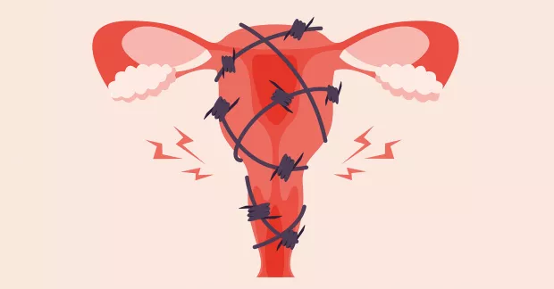 En livmoder med taggtråd runt.