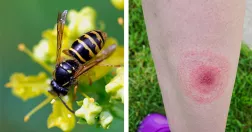 Bi på blommor och ben med fästingbett